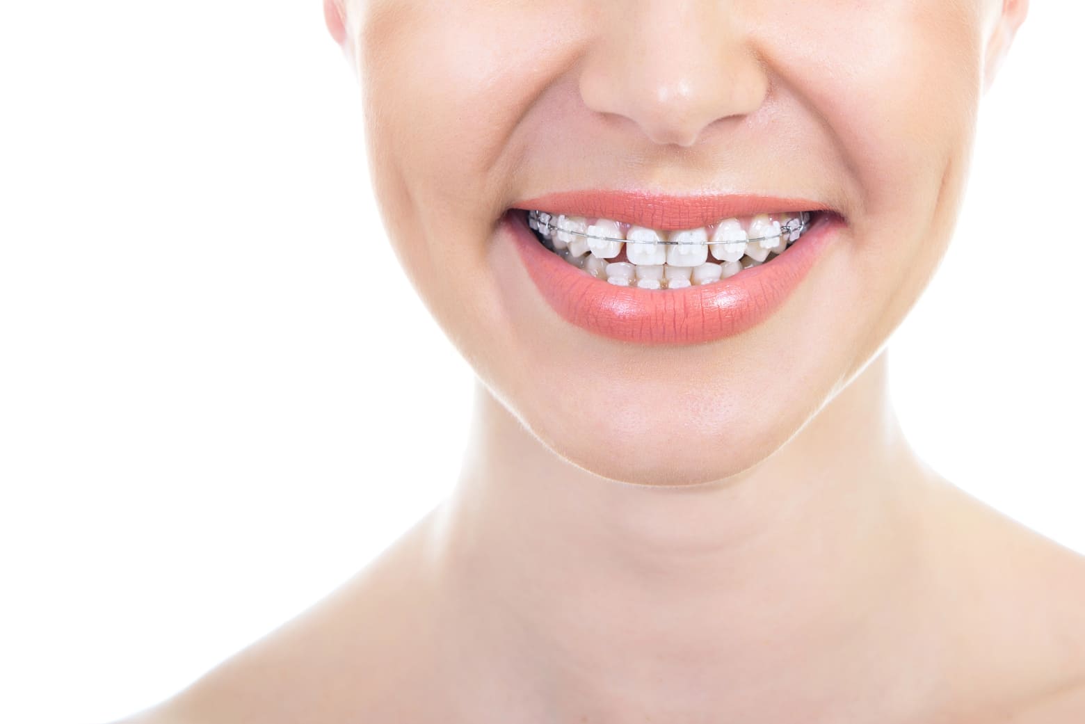 Close-up of a smiling woman wearing tooth-colored braces.